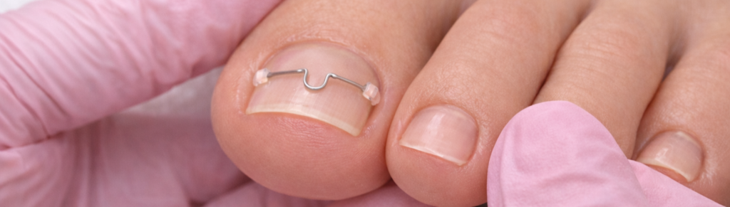 wrastający paznokieć Warszawa